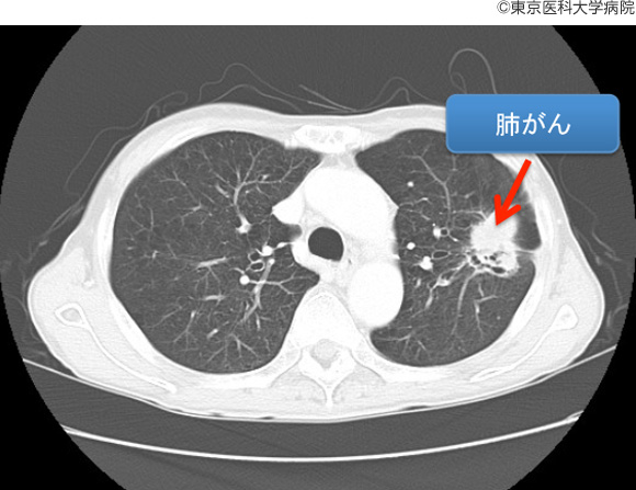 再発の可能性はありますか?