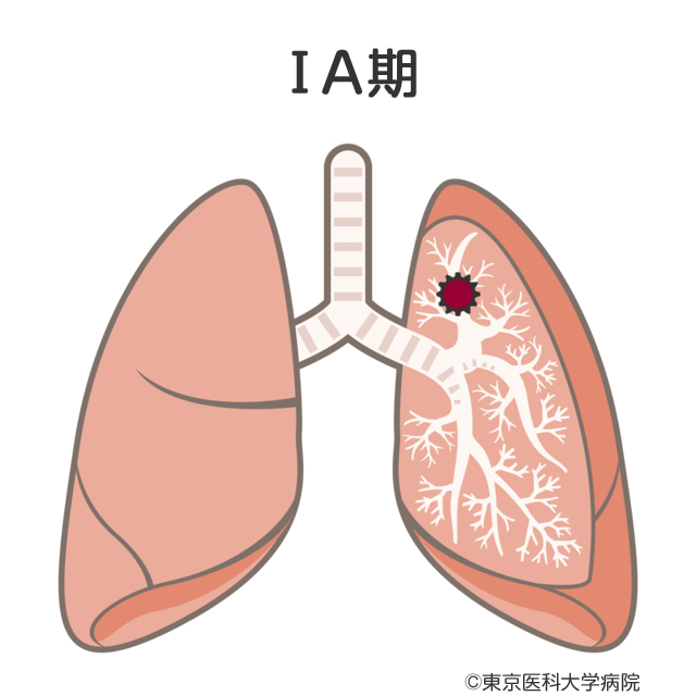 肺がんの病期 肺がん 西新宿の地で がんに挑む 東京医科大学病院