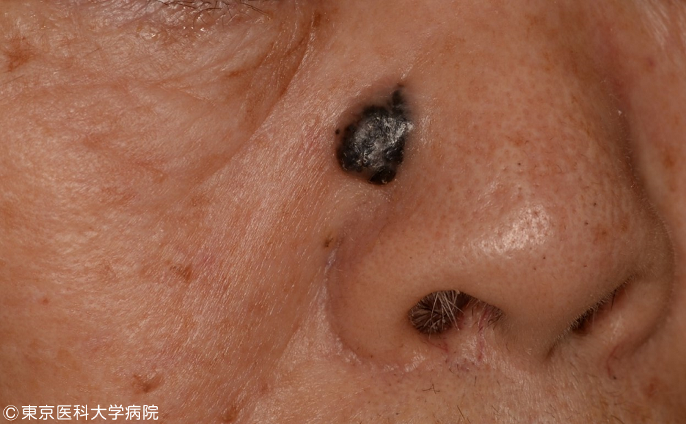 皮膚がんの種類 皮膚がん 西新宿の地で がんに挑む 東京医科大学病院
