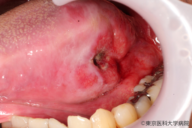 潰瘍を伴い内側にえぐれて大きくなるタイプ（内向型）