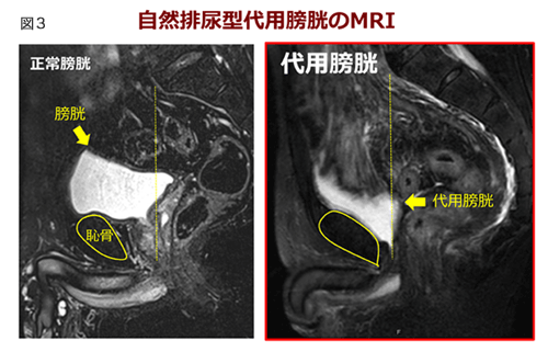 図3 自然排尿型代用膀胱のMRI