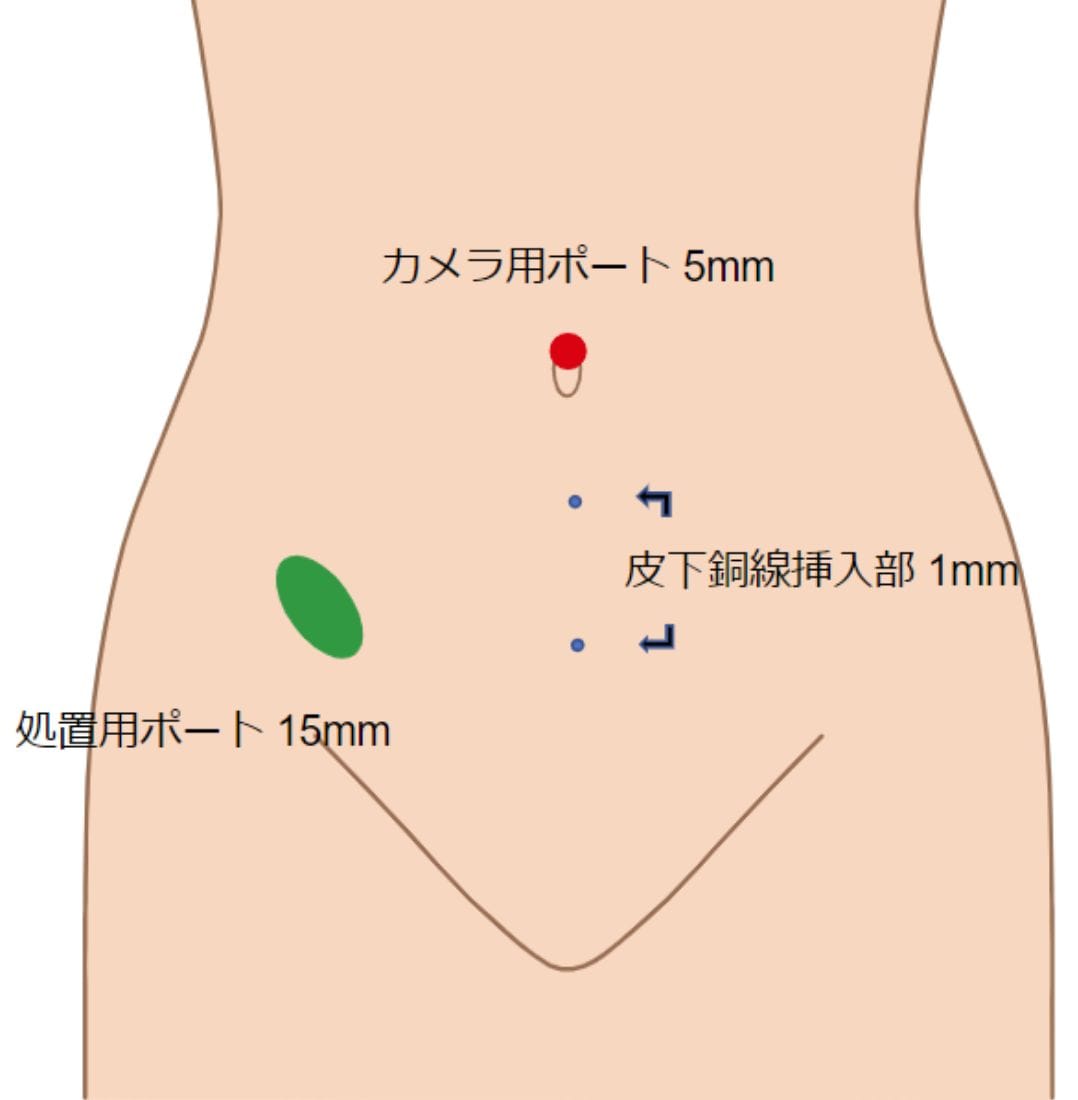 皮下銅線吊り上げ法 外観写真と創部シェーマ