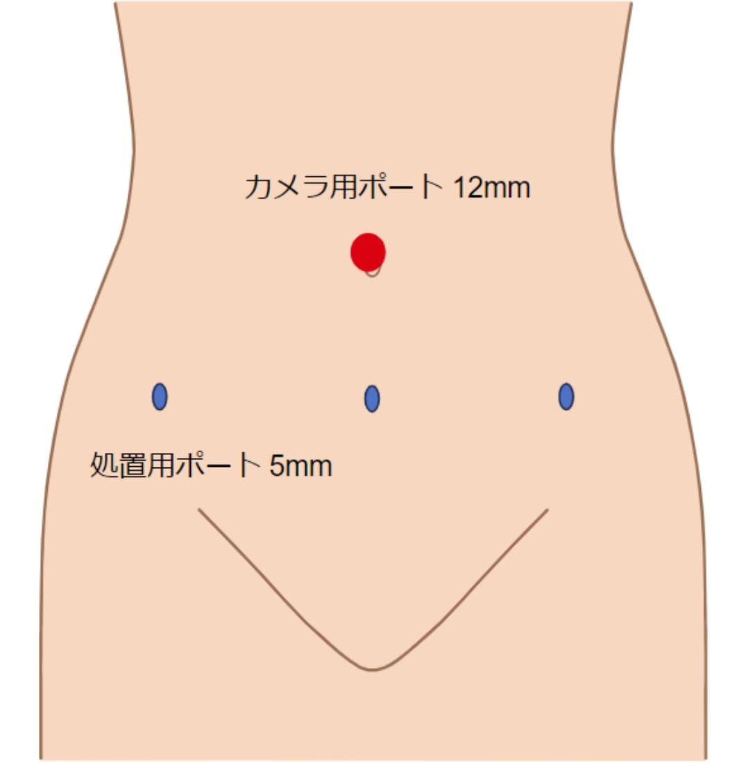気腹法の創部 外観写真と創部シェーマ