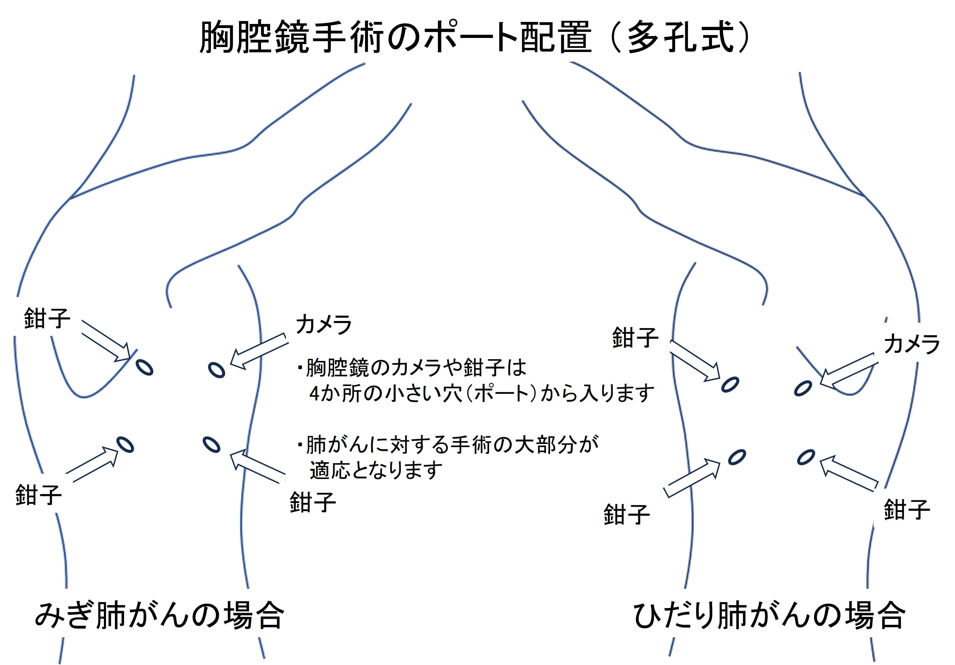 胸腔鏡手術
