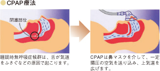 ●CPAP療法 閉塞部位 睡眠時無呼吸症候群は、舌が気道をふさぐなどの原因で起こります。 CPAPは鼻マスクを介して、一定陽圧の空気を送り込み、上気道を広げます。
