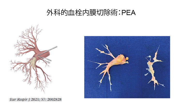 外科的血栓内膜切除術：PEA