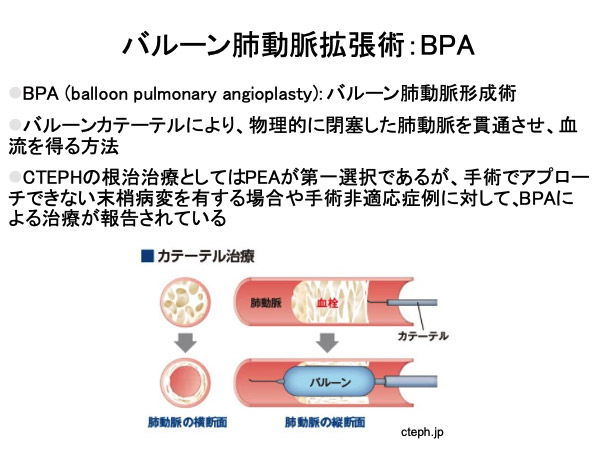 バルーン肺動脈拡張術：BPA