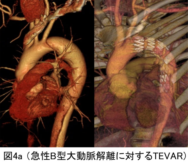 急性B型大動脈解離に対するTEVAR