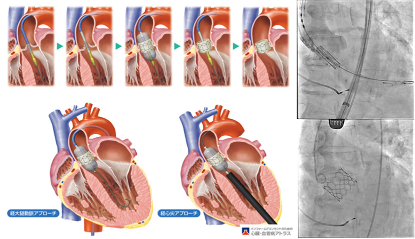 経カテーテル的大動脈弁留置術（TAVI/TAVR: Transcatheter Aortic Valve Implantation / Replacement）
