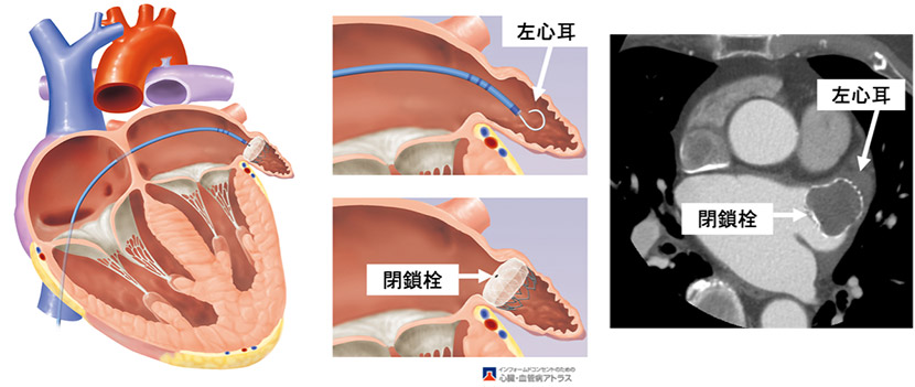 経皮的左心耳閉鎖術（LAAC: Transcatheter Left Atrial Appendage Closure）